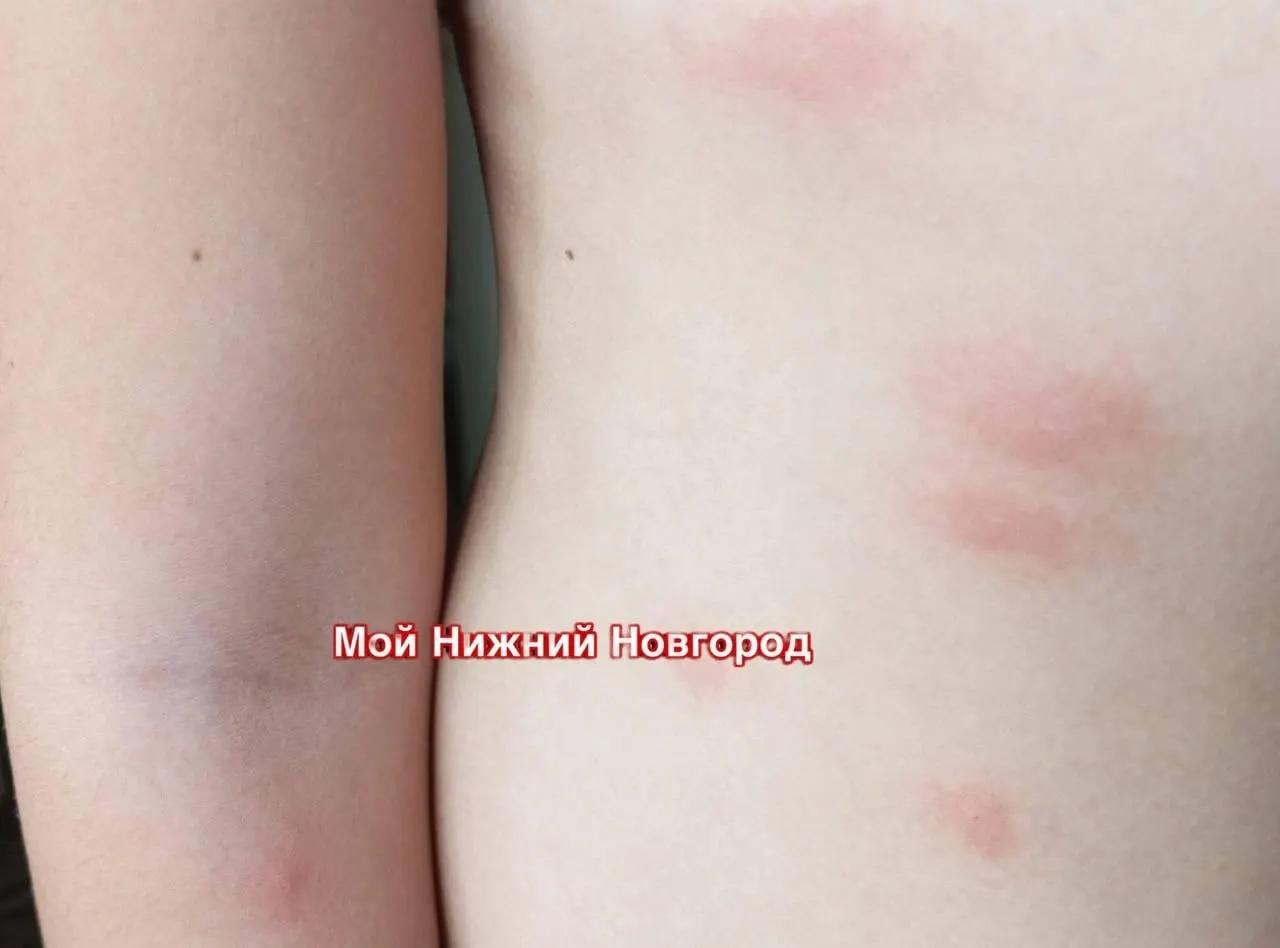 Жители Нижнего Новгорода жалуются на&nbsp;сильный зуд&nbsp;после&nbsp;купания в&nbsp;Светлоярском озере