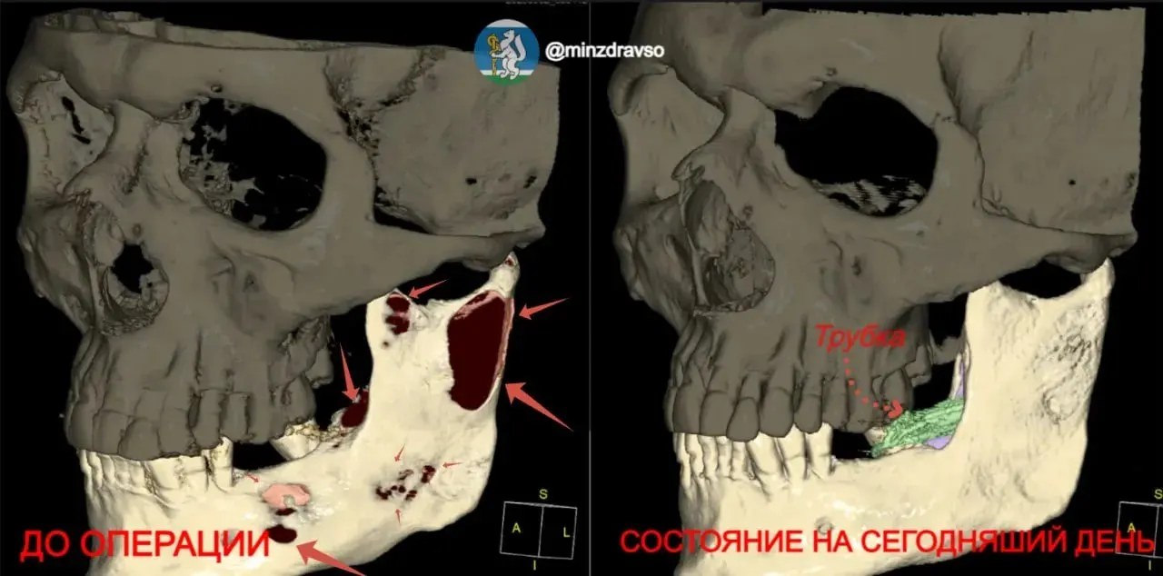 Мужчина пришёл к врачам, когда стало трудно открывать рот. На снимке выявили гигантскую кисту от коренных зубов до височно‑нижнечелюстного сустава; для полного восстановления потребуется до двух лет.