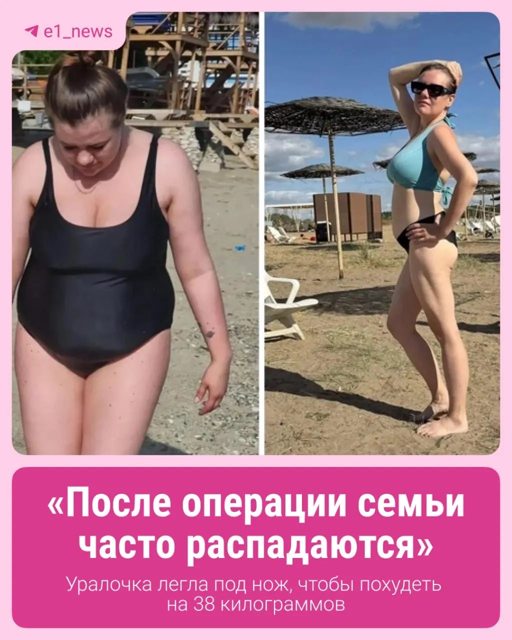 32-летняя Вероника Потапова похудела почти на 40 кг за полгода. Бариатрическая хирургия — не волшебство, а первый шаг к здоровью и новым жизненным привычкам.