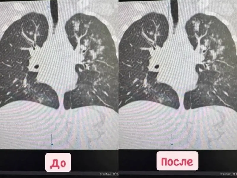 История о рисках вейпинга и пневмонии у молодой пациентки, иллюстрирующая влияние вредных привычек на здоровье.