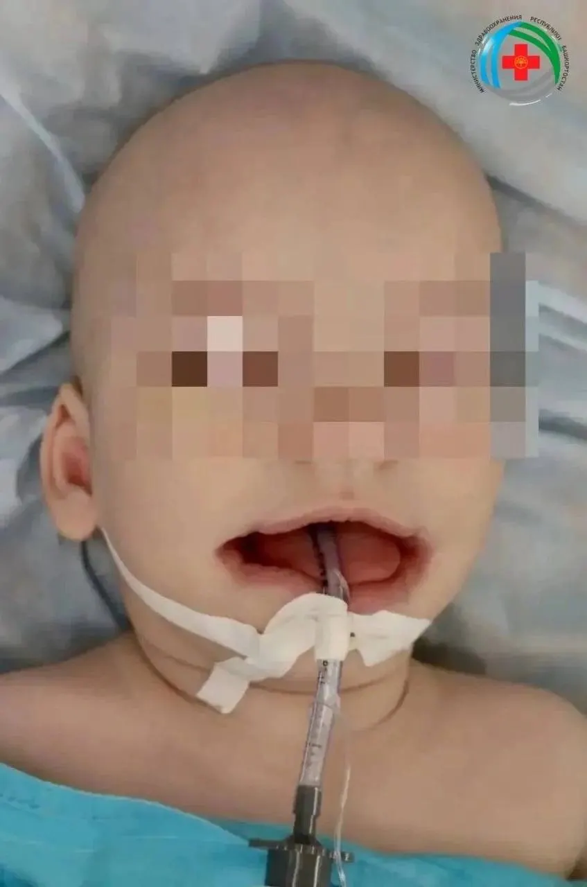 Уфимский малыш родился с редкой патологией лица: расщелины по обе стороны рта. Это далеко не только косметическая проблема — врачи восстановили пропорции губ и поражённых мышц, и сейчас ребёнок улыбается.