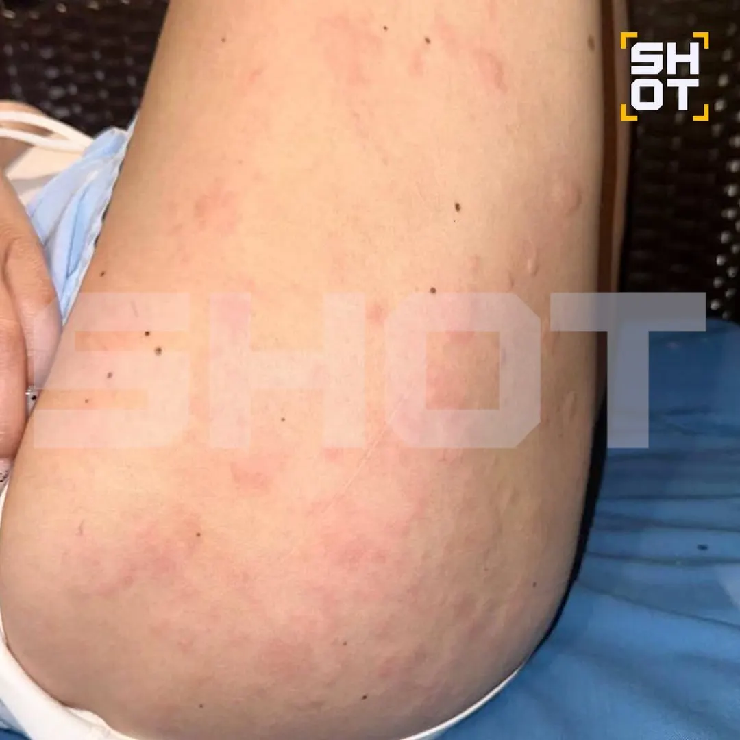 Во время поездки в Китай женщина заметила зудящие красные пятна на коже; позже последовала госпитализация и диагноз — кишечная инфекция на фоне крапивницы.