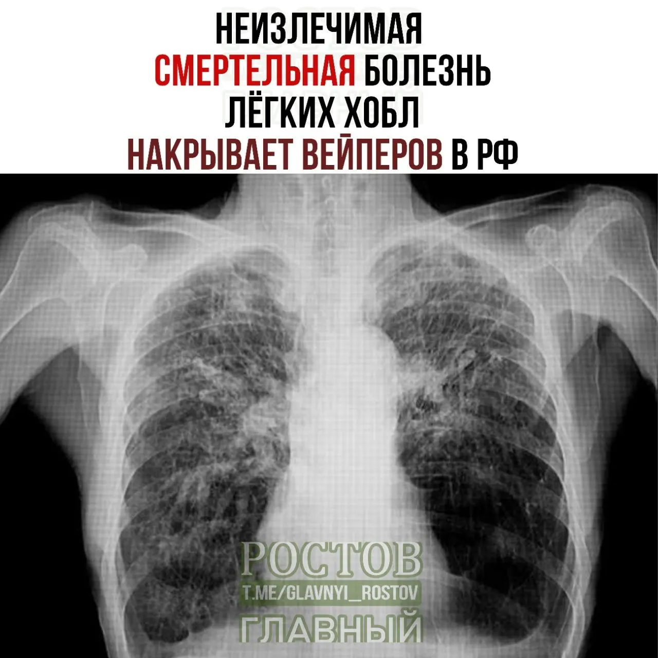 Число пациентов с ХОБЛ растёт среди молодых вейперов в России.